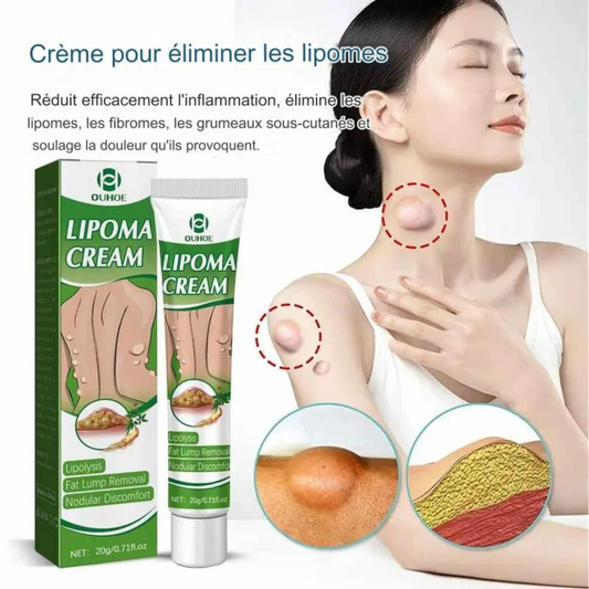 Crème d'élimination de lipomes et de taches de variole du singe.