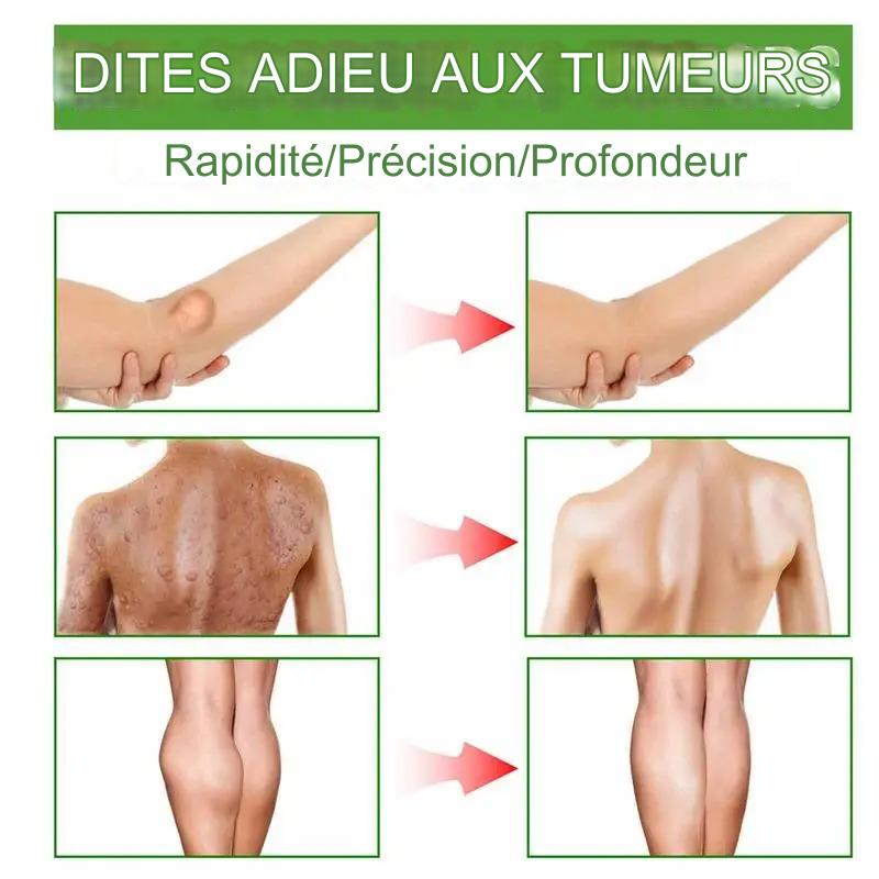 Crème d'élimination de lipomes et de taches de variole du singe.